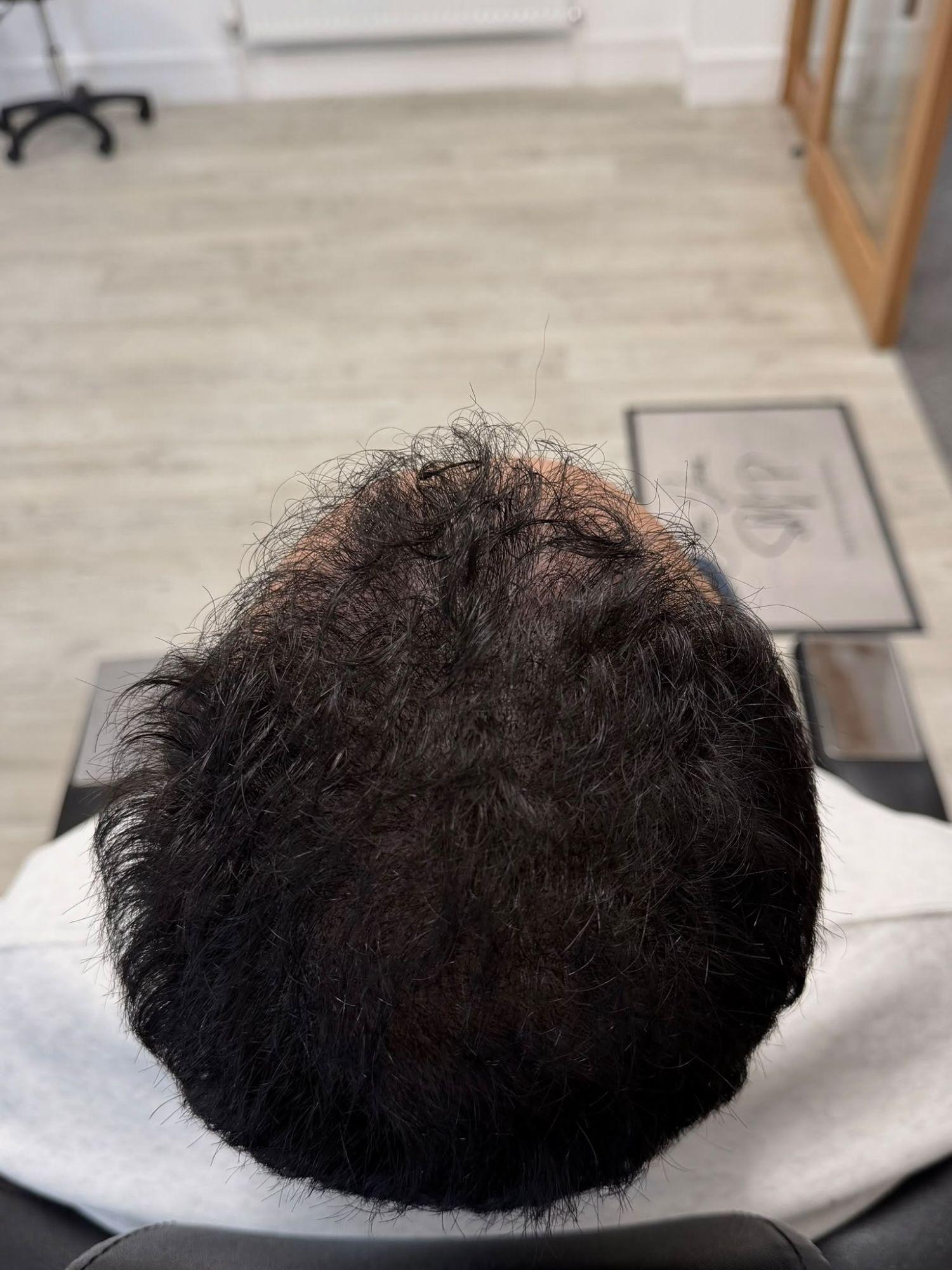The same head after scalp micropigmentation, with a fuller, denser look