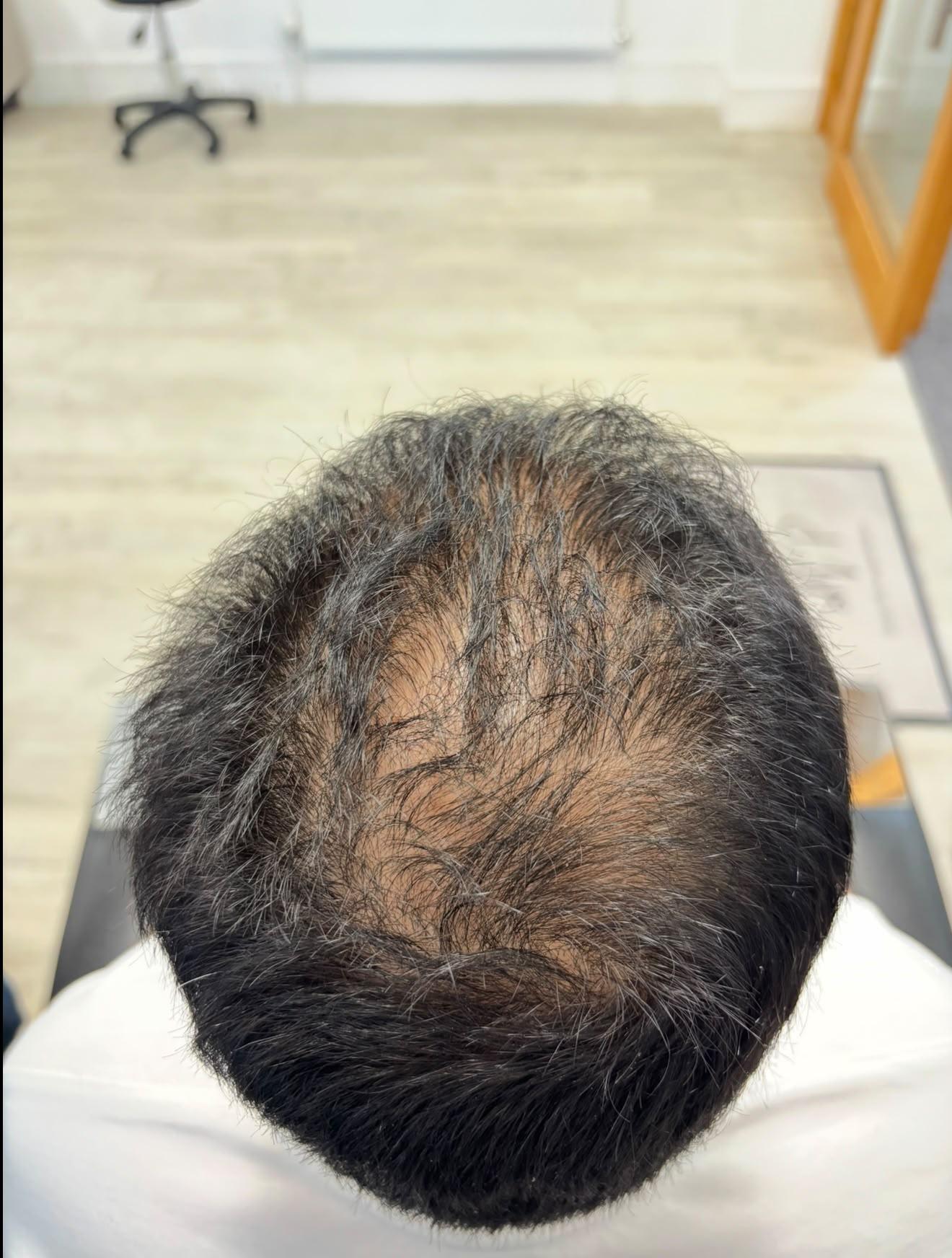 Top of the head before scalp micropigmentation, showing thinning and visible scalp